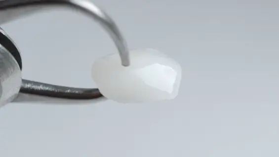 All-Ceramic and All-Porcelain Dental Crown Example Close-up of an all-ceramic and all-porcelain dental crown with a natural tooth-colored appearance for a seamless look