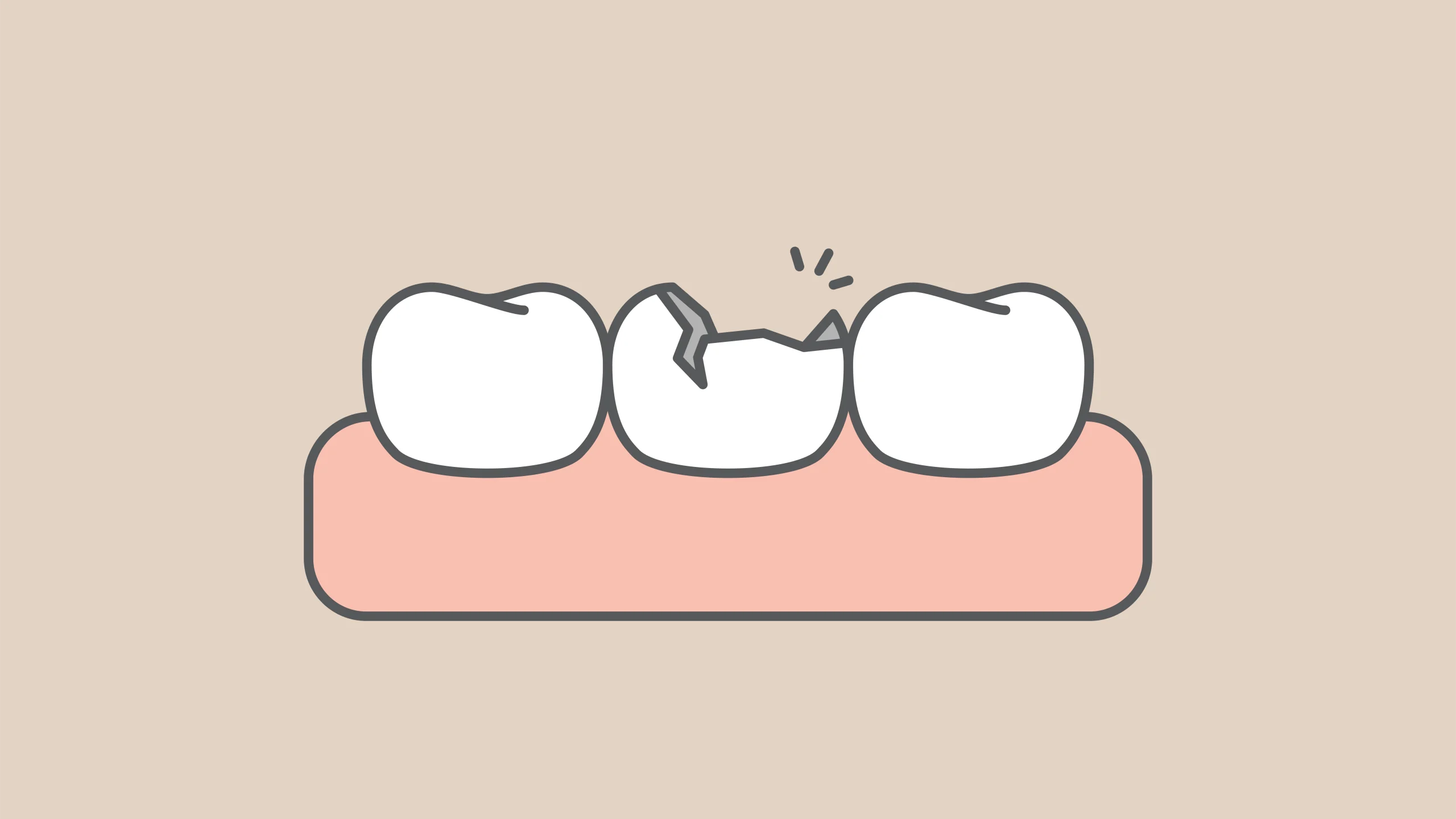 Broken Tooth Dental Emergency Close-up of a broken tooth with a visible crack or chip, highlighting a common dental emergency that may require urgent care