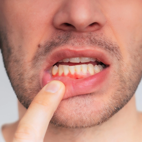 Close-up image showing gum inflammation and redness caused by gum disease