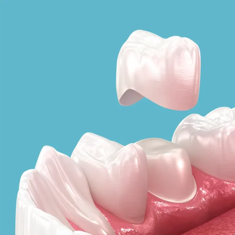 Illustration showing a dental crown placed on a tooth with labeled materials to answer the question, what are dental crowns made of