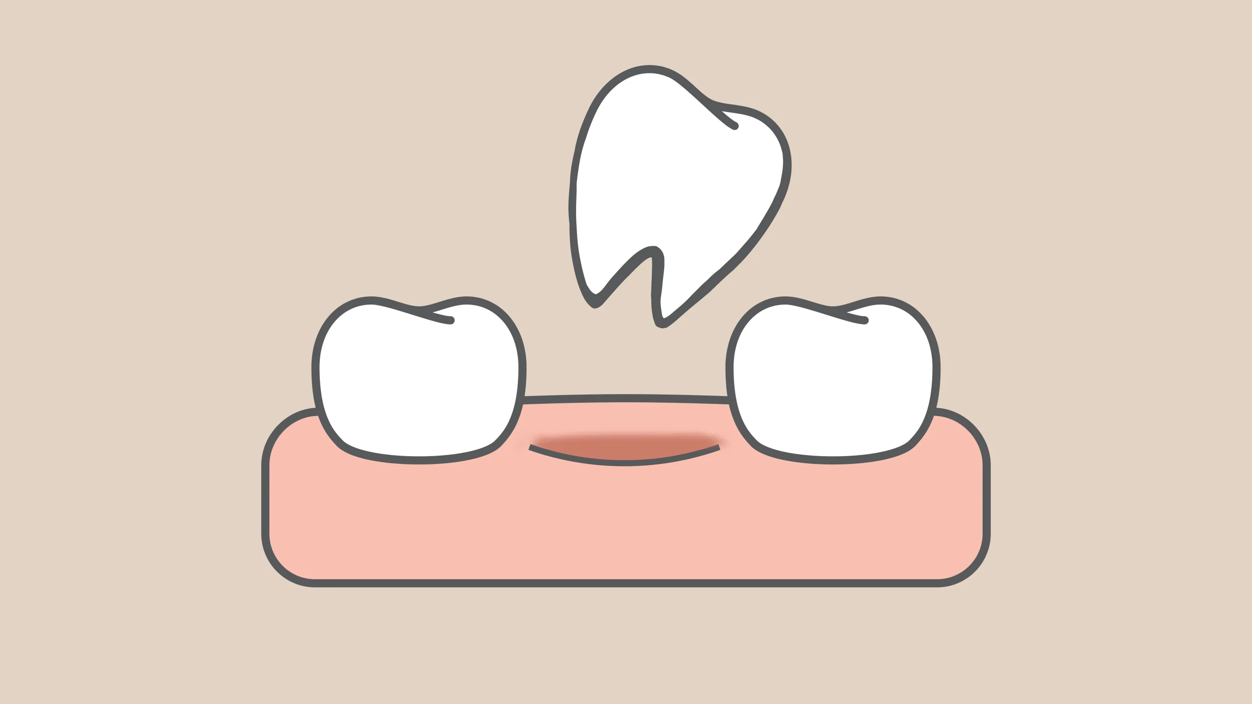Knocked Out Adult Tooth Emergency A knocked out adult tooth representing a dental emergency that needs immediate attention