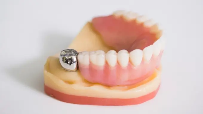 Metal Dental Crown Example Close-up photo of a metal dental crown made from gold or alloy, showing a durable metallic finish