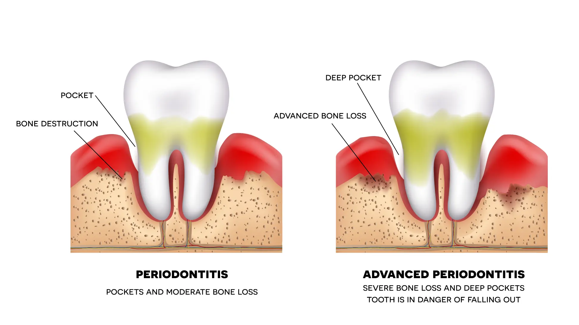 Illustration comparing a tooth with moderate gum recession from periodontitis and a tooth with severe bone loss from advanced periodontitis