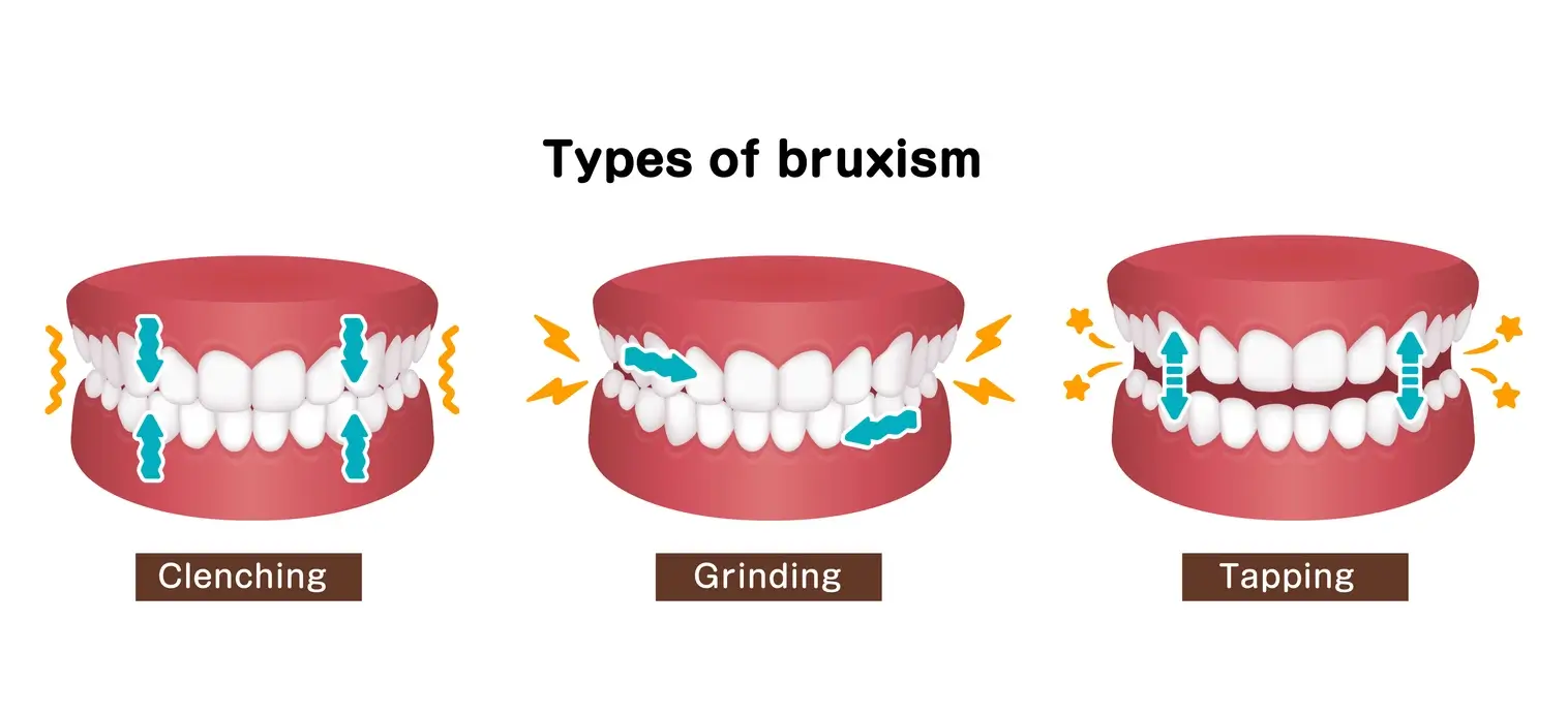 Types of Bruxism Illustration Illustration showing different types of bruxism, including awake teeth grinding and sleep teeth grinding